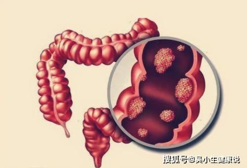 直肠癌,直肠癌的发病机制、诊断与治疗进展